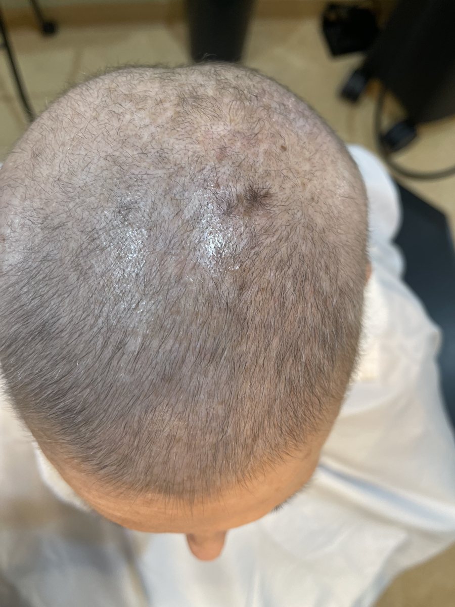 Top of the scalp showing fine new hair growth coming in after Alma TED treatments