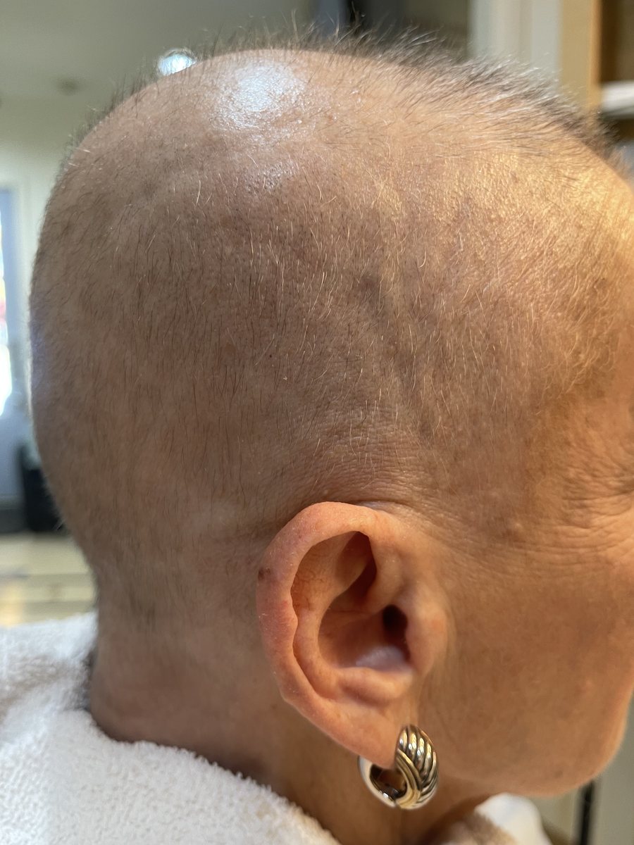 Side of the scalp showing new hair growth after Alma TED treatments