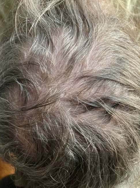 Diffuse thinning across the crown with visible scalp, six weeks after surgery
