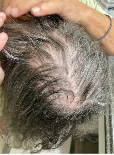Hair lifted to show reduced density and scalp inflammation at the crown