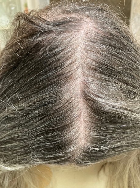 A widened parting showing diffuse shedding rather than patchy hair loss