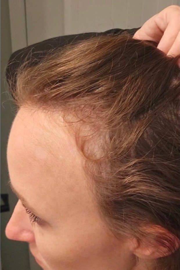 Same client's hairline and temple after four months of DE|RIVE shampoo and conditioner, February 2025