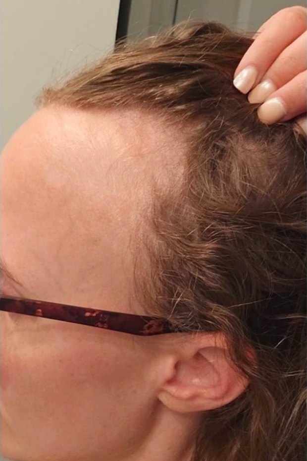 Client's hairline and temple before starting DE|RIVE, October 2024